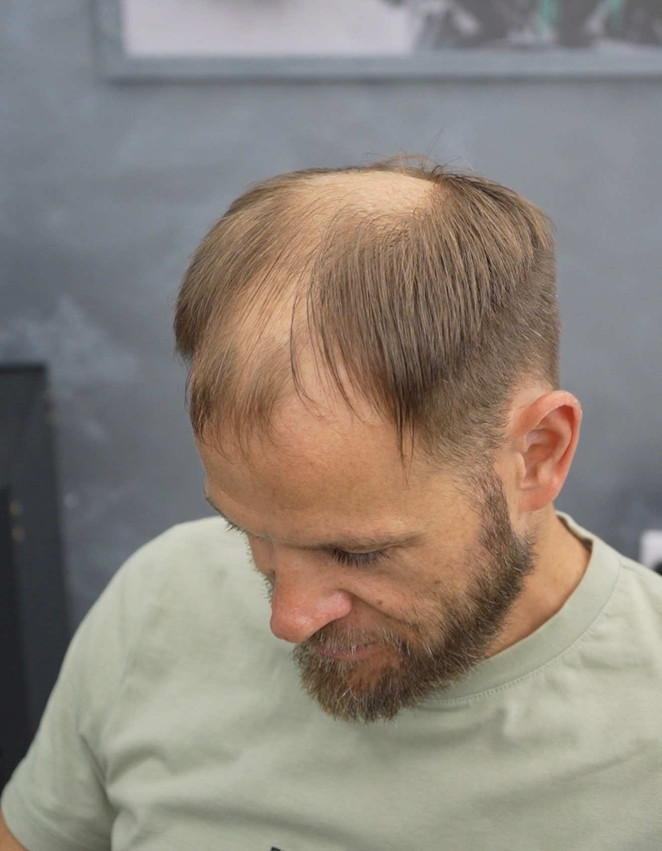 Before fitting showing the starting hairline and density.