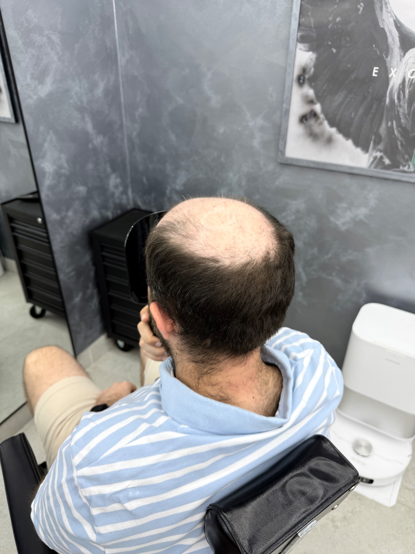 Before fitting showing the starting hairline and density.